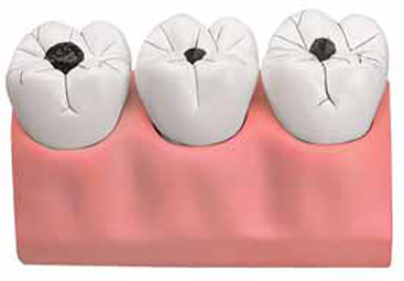 Dental Caries Model